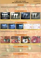 Implant poster Cristina