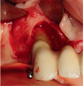 debridement-lesion-intra-osseuse