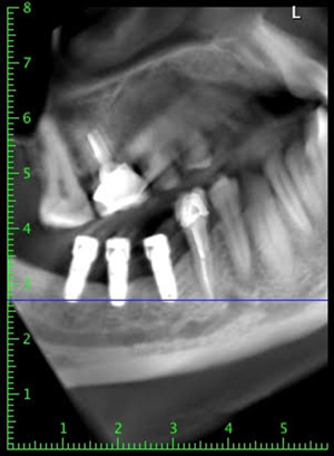 cas-de-peri-implantite2