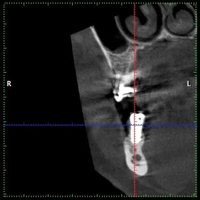 cas-de-peri-implantite4