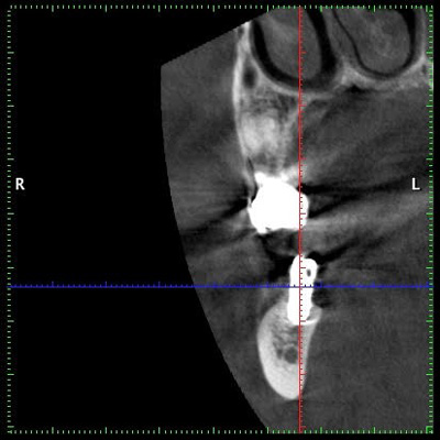 cas-de-peri-implantite5