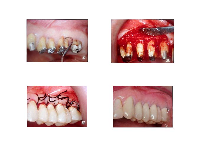 traitement-lesion-inter-radiculaire-1