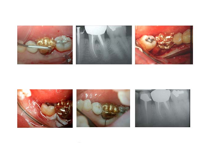 traitement-lesion-inter-radiculaire-2