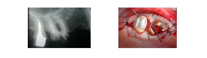 traitement-lesion-inter-radiculaire-3