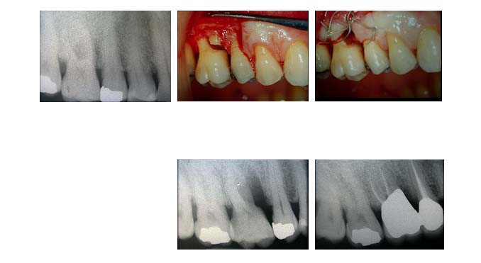 traitement-lesion-inter-radiculaire-4