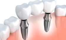 implanter une dent