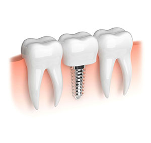 pourquoi-implant-dentaire