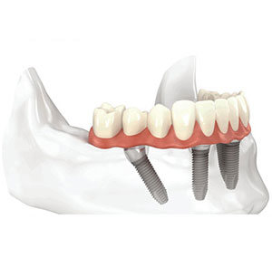 procedure-implant-dentaire