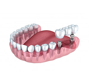 role-implant